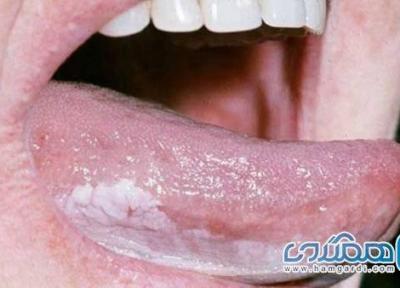 عارضه ای که منجر به سرطان دهان می گردد